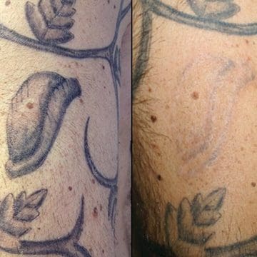 Tattoo Removal for small tattoos