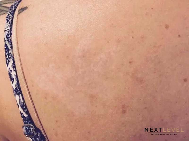 Tattoo Removal before & After Results | Next Level Clinic