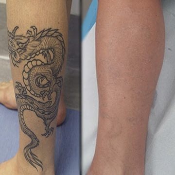 Tattoo Removal for multiple tattoos