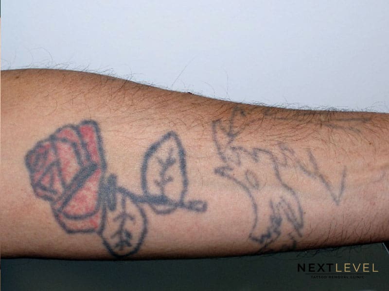 Tattoo Removal before & After Results | Next Level Clinic
